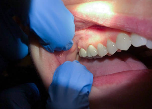 Best Emergency Treatment for Oral Infections in Burlington, IA